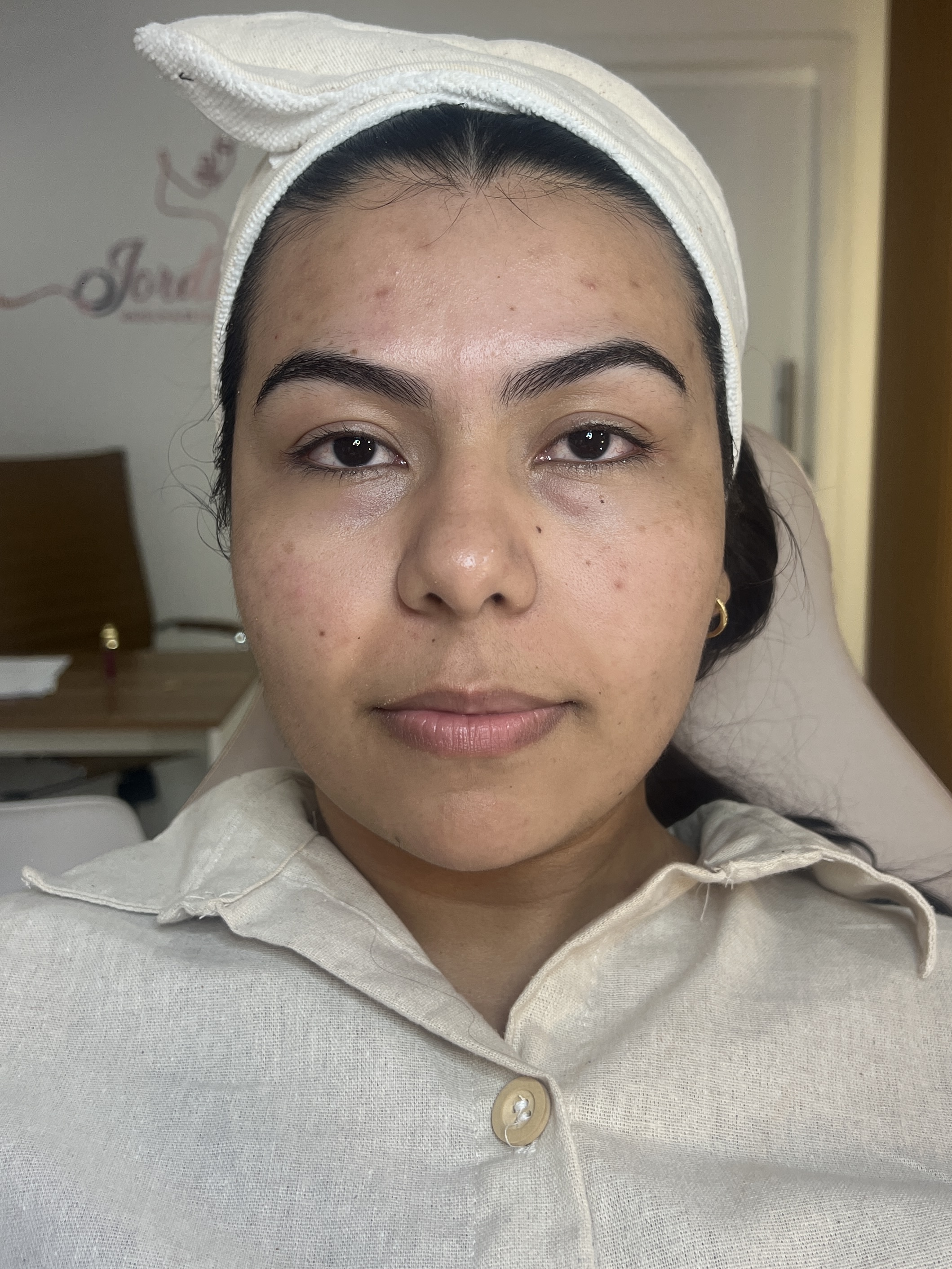 Clara antes da harmonização facial